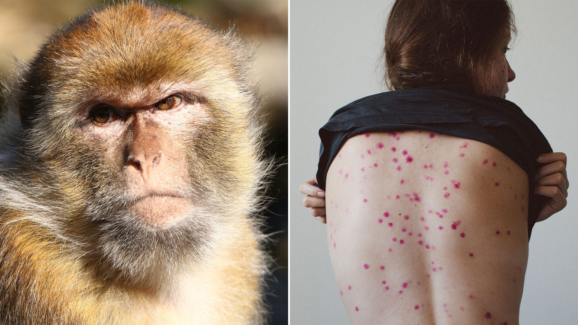 La MPOX o "Viruela del Mono": Una Nueva Amenaza Sanitaria